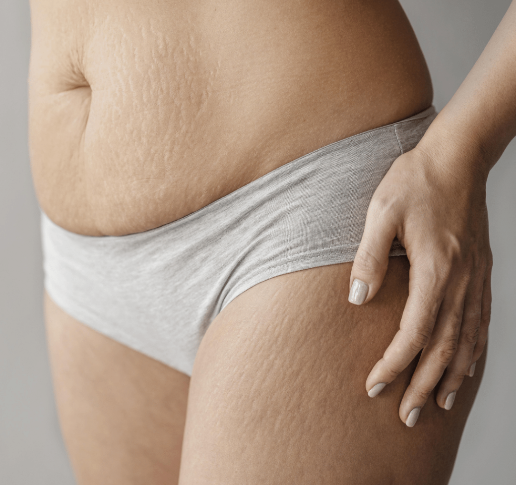 Why do stretch marks appear? What You Need to Know