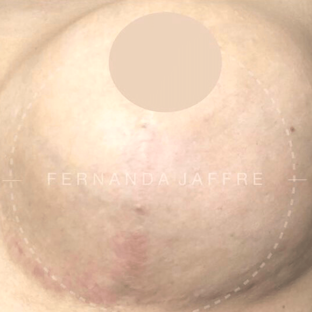 after scar cover up for breast surgery