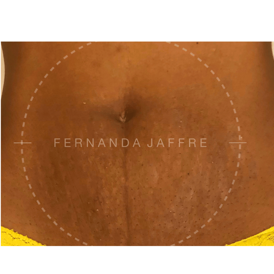 after tummy tuck with stretch marks
