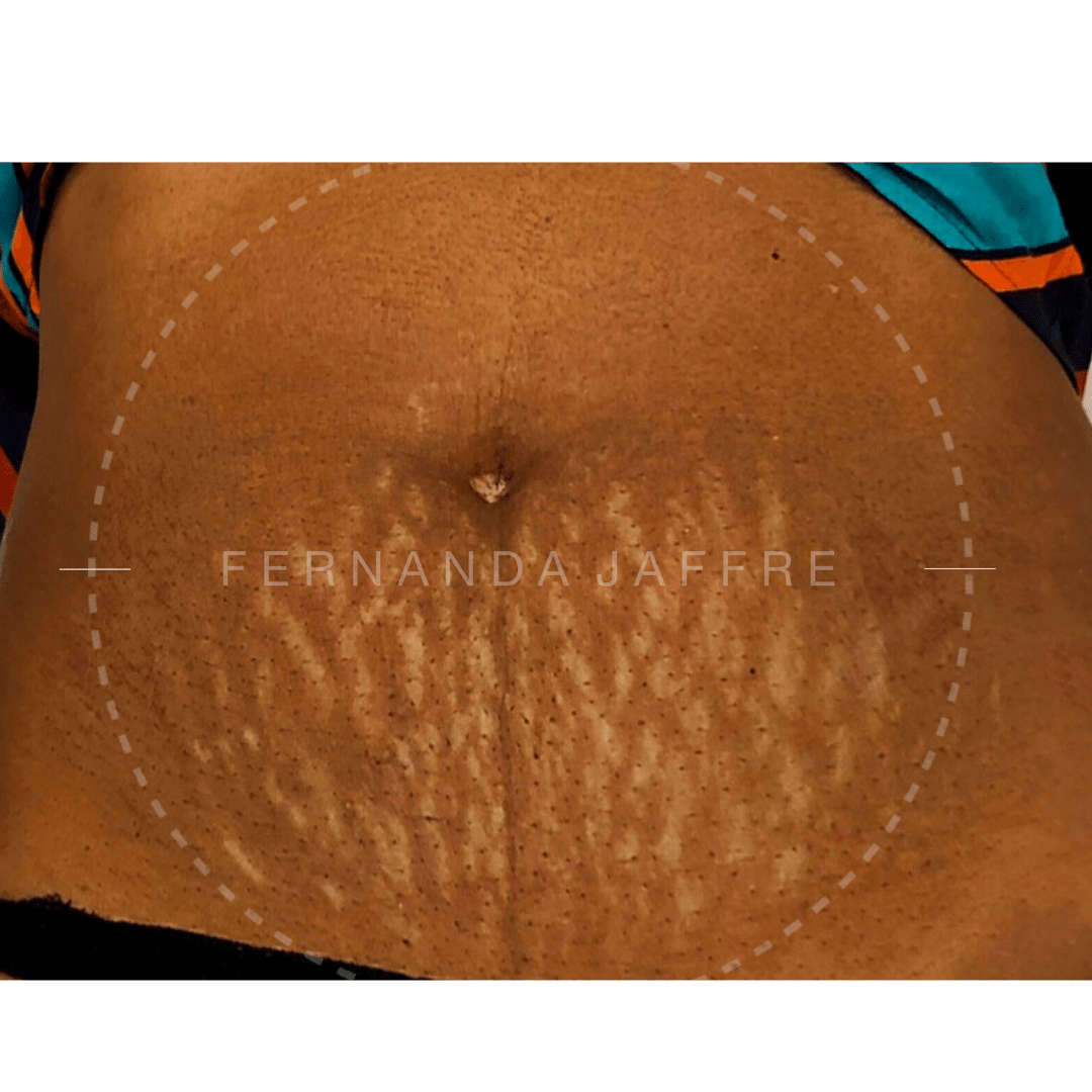 before tummy tuck with stretch marks