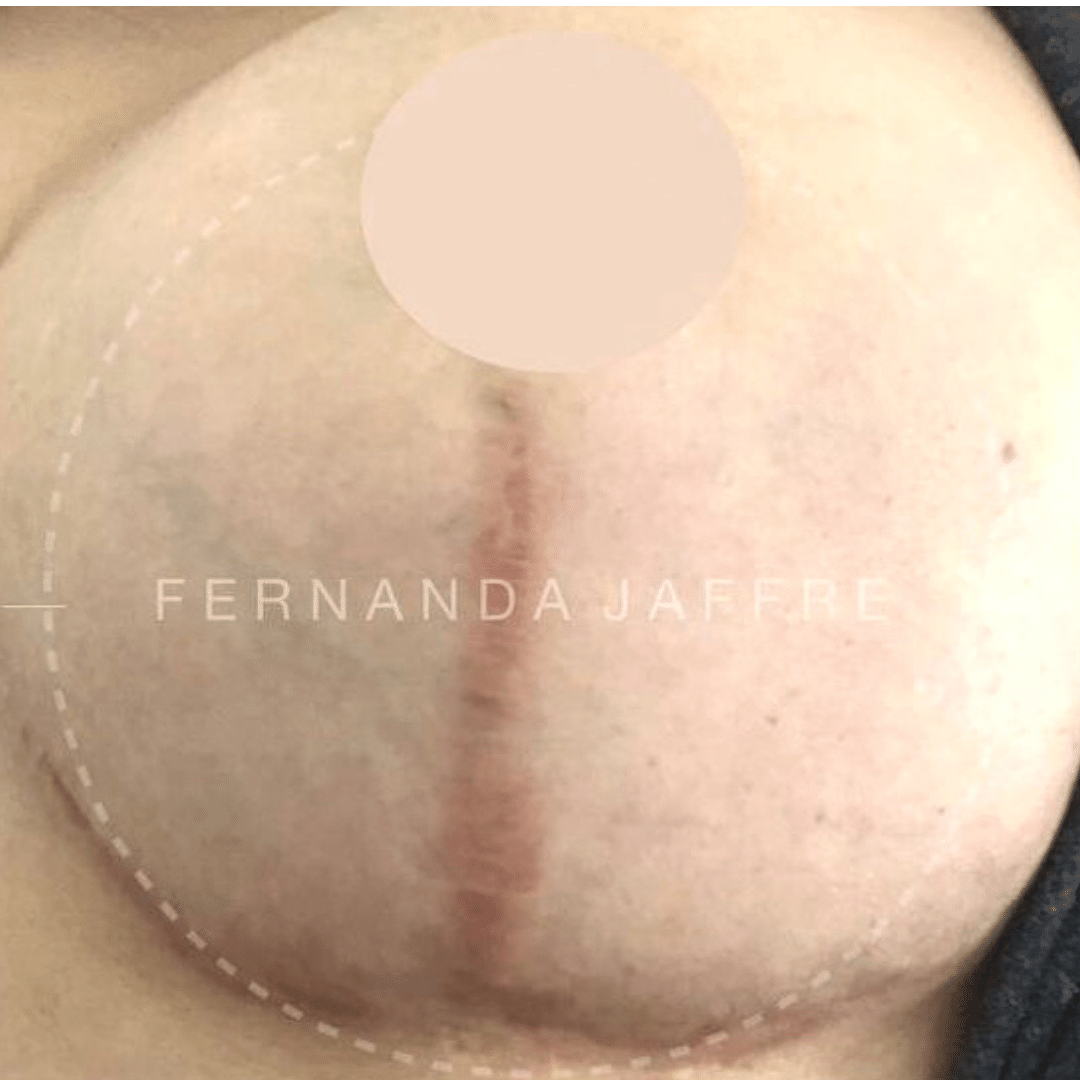 before scar cover up for breast surgery