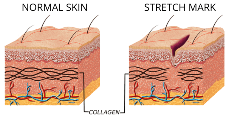 normal skin vs skin with stretch marks