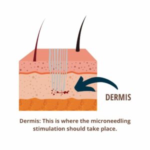 Dermis: This is where the microneedling stimulation should take place.