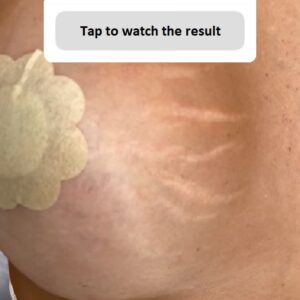 Stretch marks from cosmetic breast implant surgery before and after.