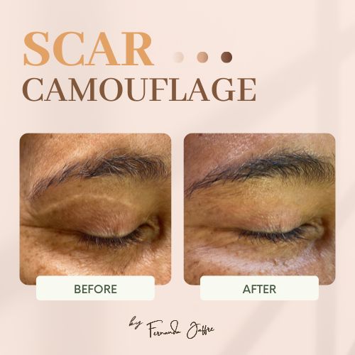 Scar camouflage tattoo before and after lift blepharoplasty scar