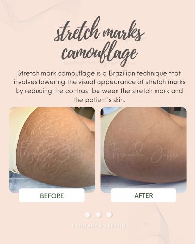 stretch mark camouflage tattoo results before and after