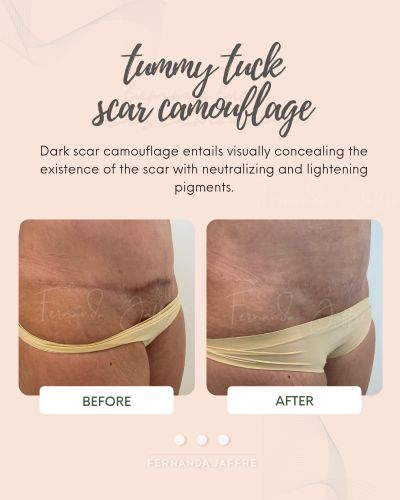 tummy tuck scar camouflage results before and after