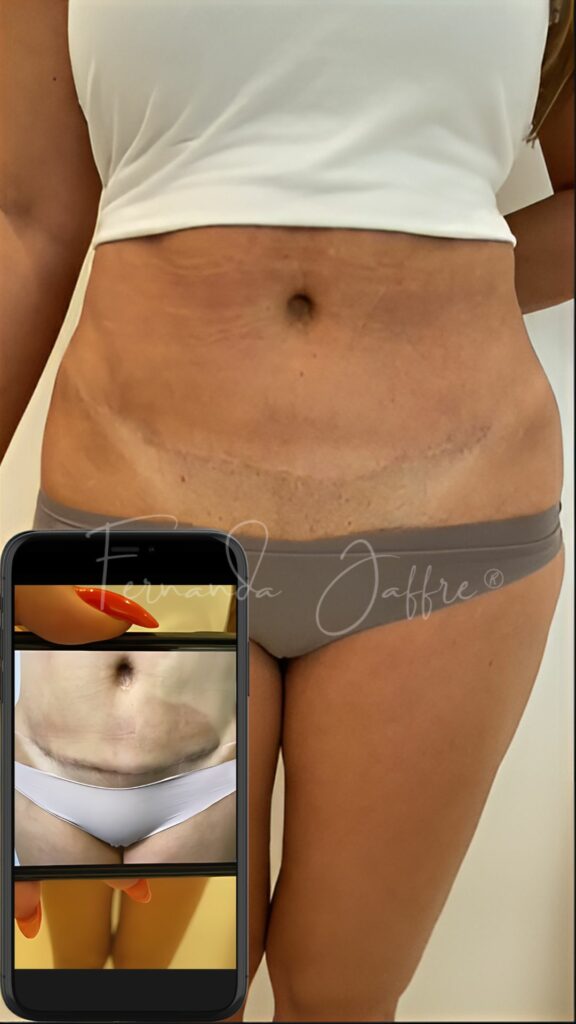 Before and after images of a tummy tuck scar camouflage tattoo, highlighting significant scar reduction and improved skin appearance.