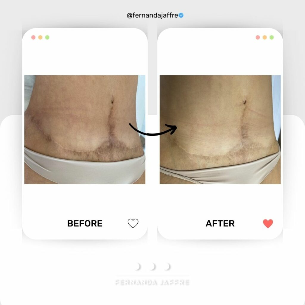 Anchor line Tummy Tuck Scar concealing before and after