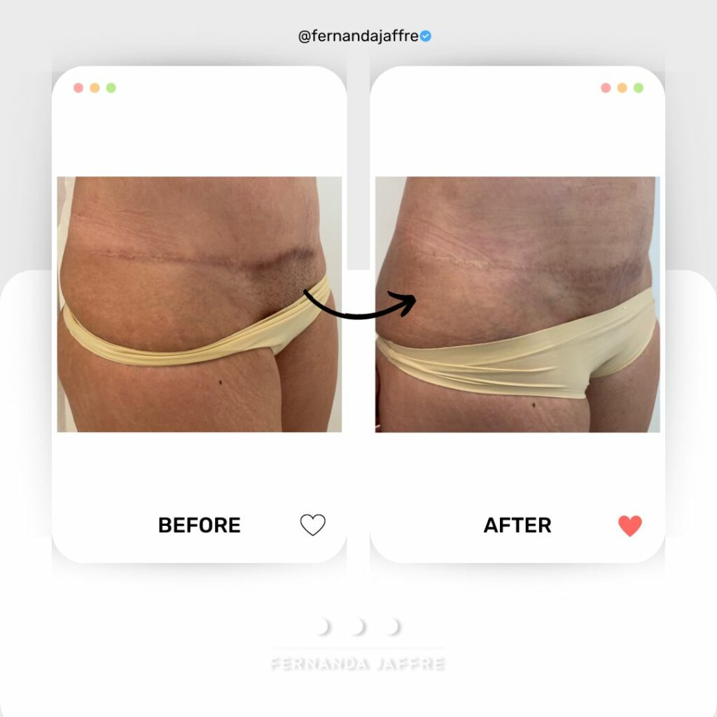 Before and after Tummy Tuck Scar concealing