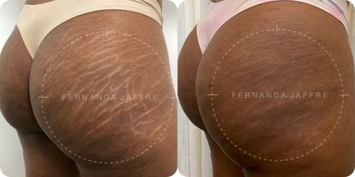 Before and after images of a stretch mark camouflage tattoo on black skin, highlighting the improved skin tone and reduced visibility of stretch marks.