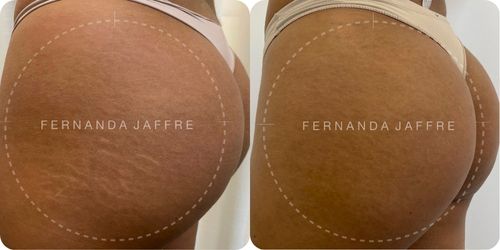 Before and after images of stretch mark tattoo camouflage on the buttocks, highlighting the improved skin appearance and reduced visibility of stretch marks.