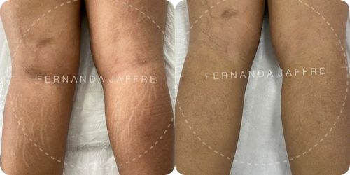 Before and after images of stretch mark tattoo camouflage on the calf, showcasing improved skin appearance and reduced visibility of stretch marks.