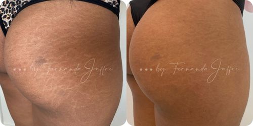 Before and after images of Brazilian stretch mark camouflage tattoos, showing the transformation and improved skin appearance after treatment.