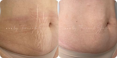 Before and after results of stretch mark tattoo camouflage on the abdominal region, highlighting significant improvement in skin appearance.