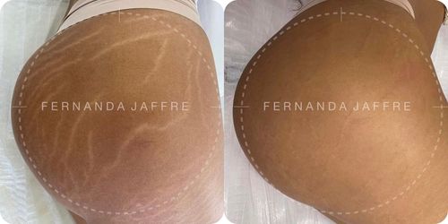 Before and after images of skin tattoo on stretch marks in the gluteal region, showing significant improvement in skin texture and appearance.