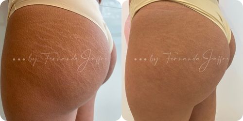 Before and after results of Brazilian stretch mark tattoo camouflage, showcasing improved skin texture and reduced appearance of stretch marks