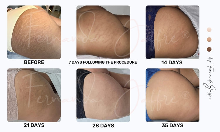 The image depicts the healing phase of stretch mark camouflage.