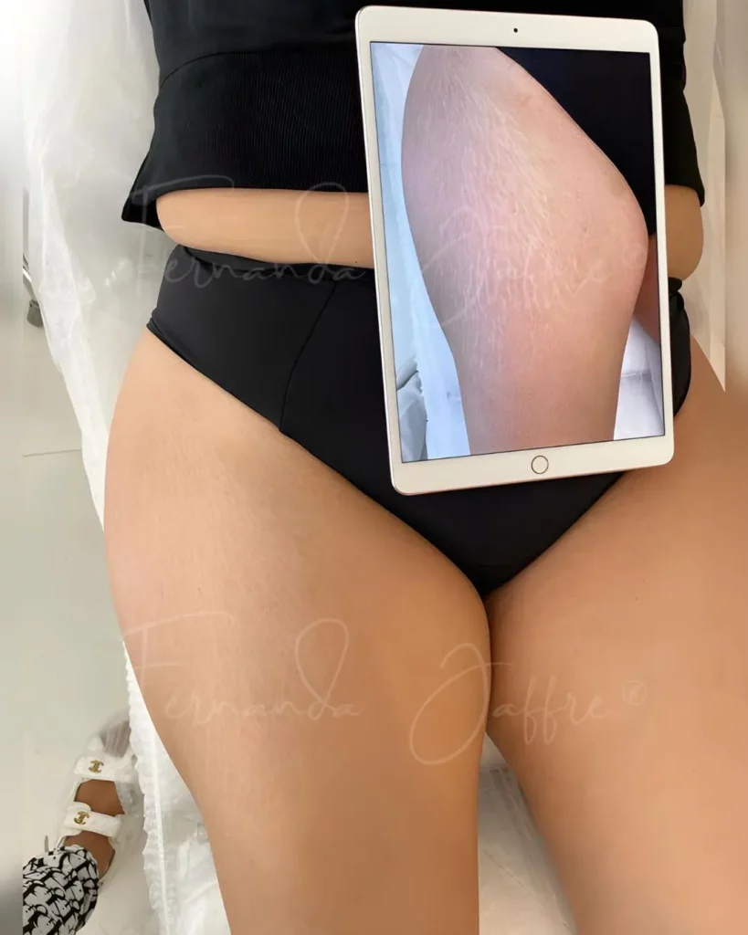 Before and after results of stretch mark tattoo camouflage, highlighting the reduction in visibility and improved skin appearance.