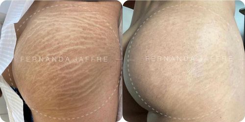 Before and after images of stretch mark tattoo camouflage, showing a notable reduction in stretch marks and smoother skin on the treated area.