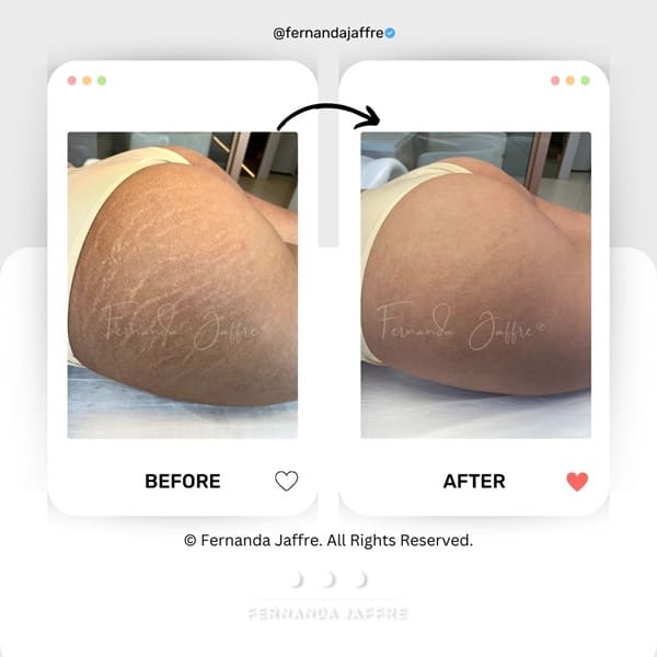 stretch marks tattoos before and after