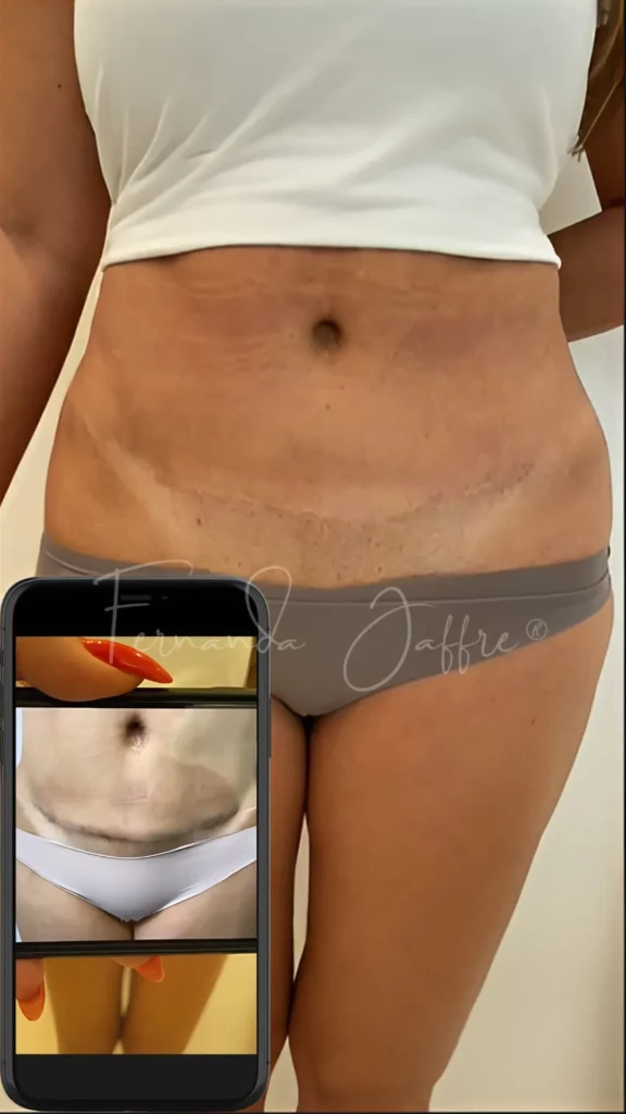 tummy tuck scar tattoo camouflage before and after