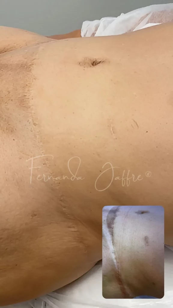 tummy tuck scar tattooing camouflage before and after
