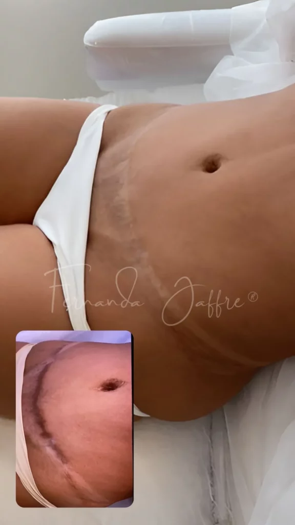 tummy tuck scar tattoos camouflage before and after