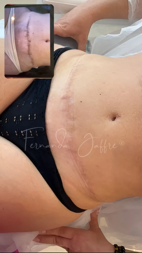 tummy tuck scars tattoo camouflage before and after