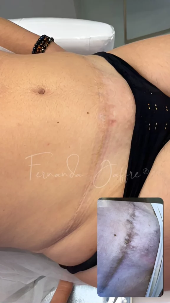 tummy tuck scars tattoos camouflage before and after